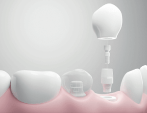 Zirconia Implant illustration